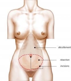 schéma abdominoplastie