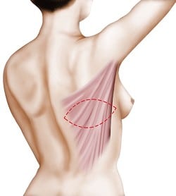  reconstruction mammaire par grand dorsal 