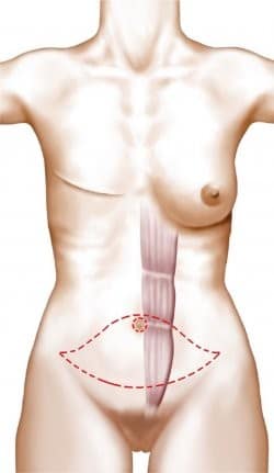 schéma reconstruction du sein par grand droit de l'abdomen