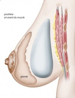schéma prothèse mammaire